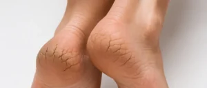 فوائد الفكس مع تخفيف تشقق القدمين والكعبين